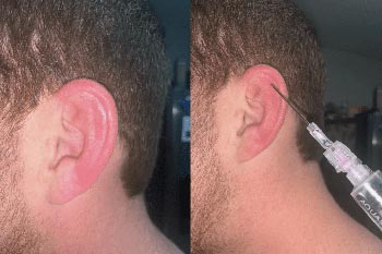 A man with cauliflower ear has it drained using a needle.